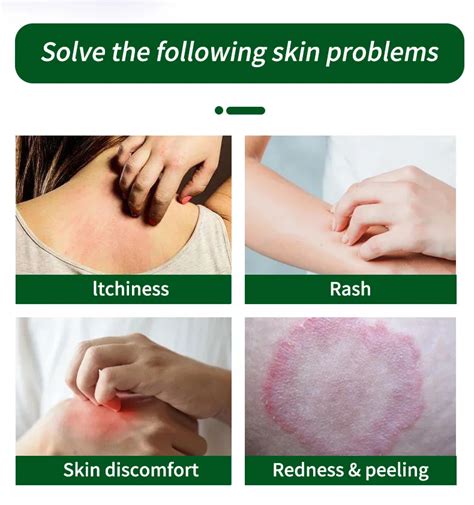 Free Sample Dermatitis Eczema Fungal Infection Ointment For The