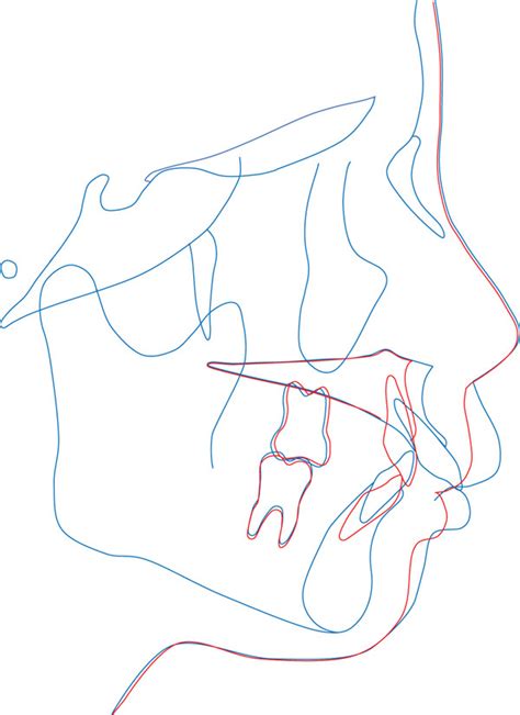 Maxillary Protrusion With Severe Overjet Treated By Maxillary Anterior