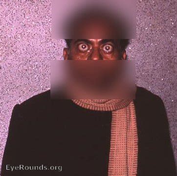 Bilateral exophthalmos. EyeRounds.org: Online Ophthalmic Atlas