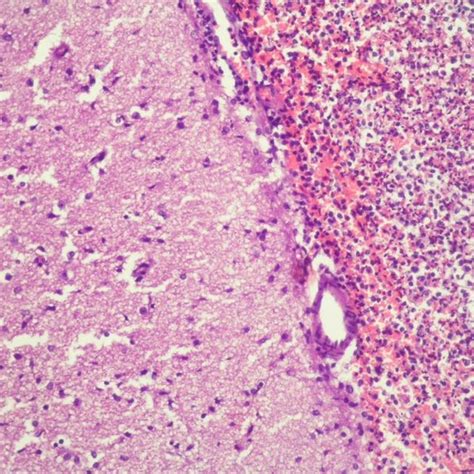 Hydropic Degeneration Of The Epithelium Of The Straight Tubules