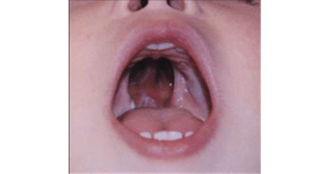 Developmental Abnormalities White Lesions Pigmented Lesions Exam