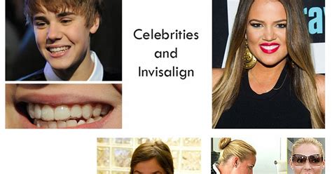 Toronto Invisalign Brand New Smile Celebrities And Invisalign