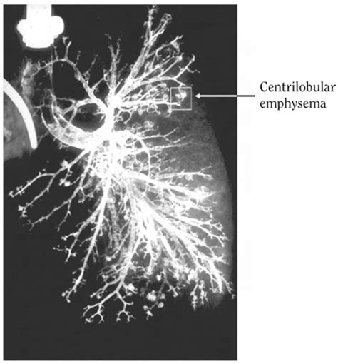 Figure 7.7, Postmortem bronchogram performed on the lungs of a person ...