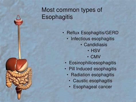 Hsv Esophagitis Endoscopy : Atypical Manifestation Of Herpes ...