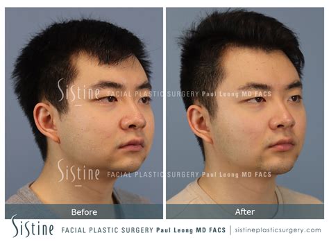 Jawline Surgery Men Before And After