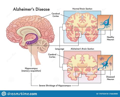 What is Alzheimer’s disease? - Krystal Family Clinic