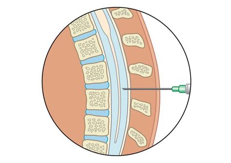 I Had A Spinal Tap And Now Have A Headache Lumbar Puncture Digital