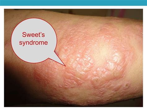 Atypical Presentations Of Erythema Nodosum Leprosum A Case Report And