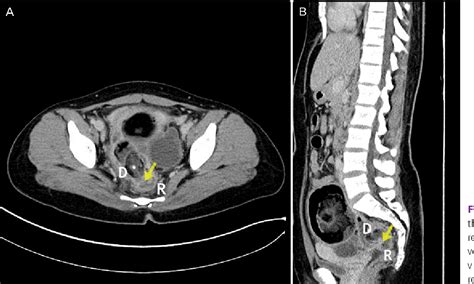 Figure 1 From Laparoscopic Repair Of A Rectal Fistula Due To A Benign