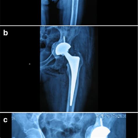 A Left Hip Exhibiting Rheumatoid Arthritis Ra With An Acetabular Download Scientific Diagram