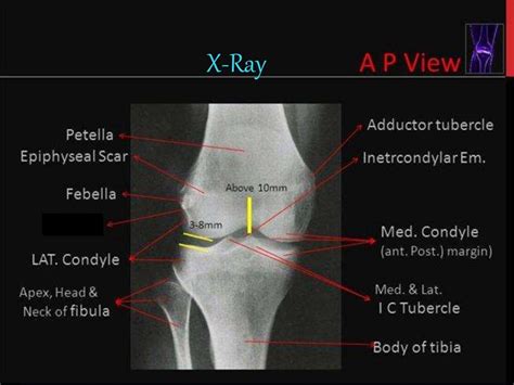 Anatomy Of Knee Joint : Anatomy Knee Joint | KLINIK am RING : The knee joins the thigh bone ...