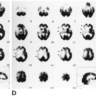 Woman 82 years old with left hemiparesis diagnosed as minor stroke. A ...