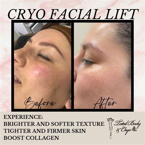 Cryo Facial Lift | Cryo facial, Facial, Skin firming