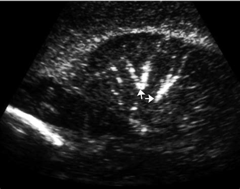 178 Thalamostriate Vasculopathy In The Neonate Is Associated With