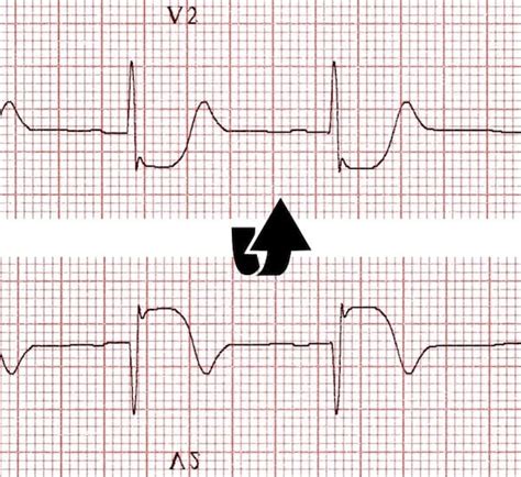 Posterior Myocardial Infarction Ecg