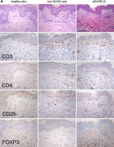 Histology And Immunohistochemistry For Cd Cd Cd And Foxp T