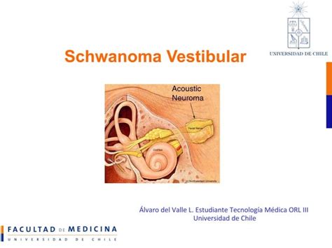 Neurinoma Del Ac Stico Ppt