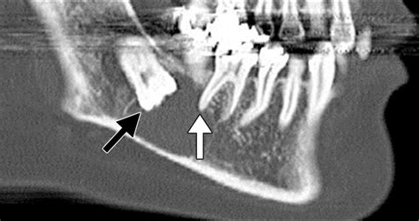 Periapical Lucency Around The Tooth Radiologic Evaluation And