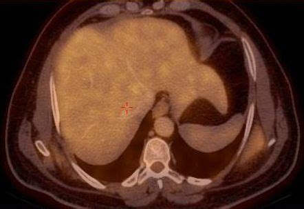 Elastofibroma Dorsi PET CT Radiology Case Radiopaedia Org