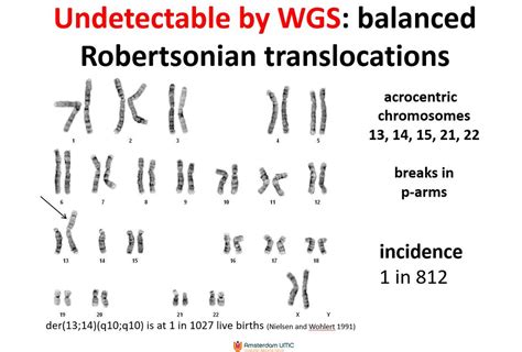 Translocation Down Syndrome Karyotype