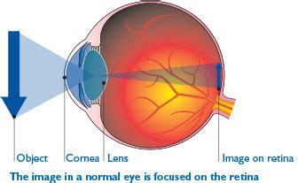 Macular Pucker | Rand Eye Institute