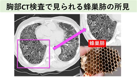 間質性肺炎｜名古屋おもて内科・呼吸器内科クリニック｜荒畑駅・御器所駅