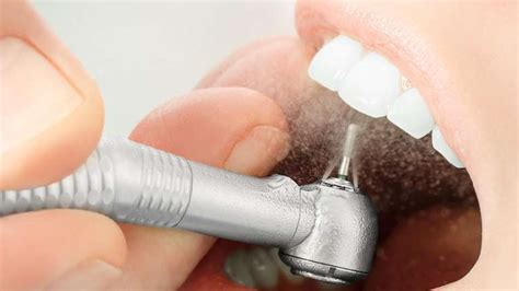 Everything You Need to Know About Filling a Cavity | Champaign IL