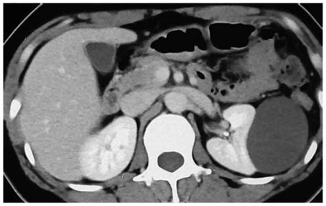 Renal / Kidney Cyst - Urology Clinic in Selangor Malaysia