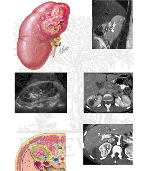 Intrarenal And Perinephric Abscesses