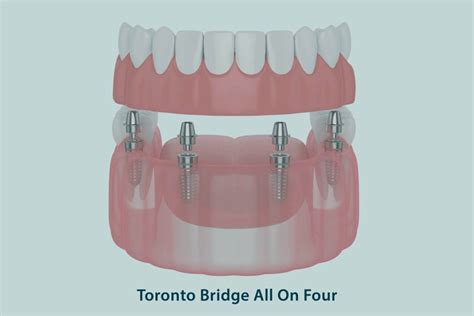 Carico Immediato Di Scuola Italiana O Toronto Bridge Su All On Four