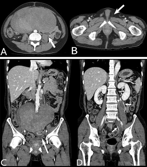 An Axial Contrast Enhanced Computed Tomography CECT Scan Shows An