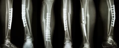 Fractures And Broken Bones In A Motor Vehicle Accident Louisville Ky