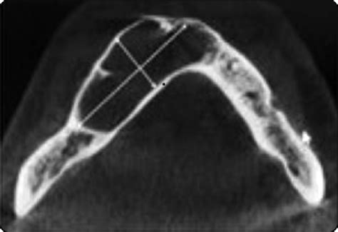 Keratocyst Axial View Of Cone Beam Computed Tomography Image Showing A Download Scientific