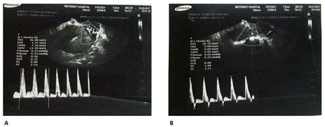 The Transvaginal Color Doppler Ultrasound Results Pulsatility And