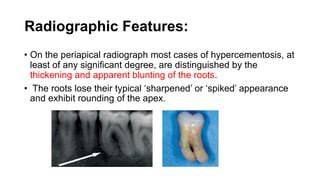 Hypercementosis | PPT