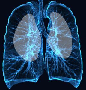 Diagram Alveolar Proteinosis | Lungs