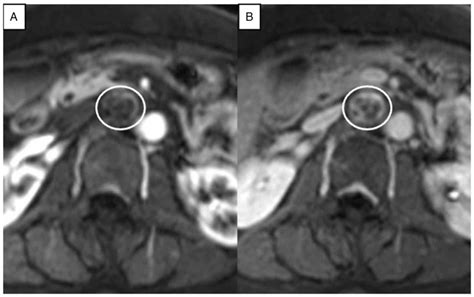 Primary Anastomosing Hemangioma As A Preoperative Diagnostic Mimicker