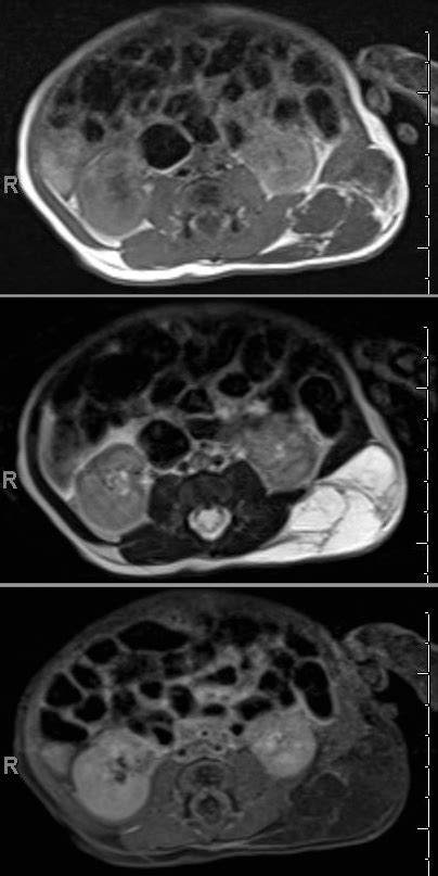 Lymphatic Malformations, a pediatric clinical case review and discussion