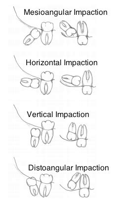 Types of #Wisdom Teeth Impactions Based on Angulations of Tooth ...