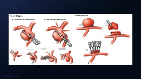 343 Pterional Craniotomy For Clip Reconstruction Of A Dolichoectatic