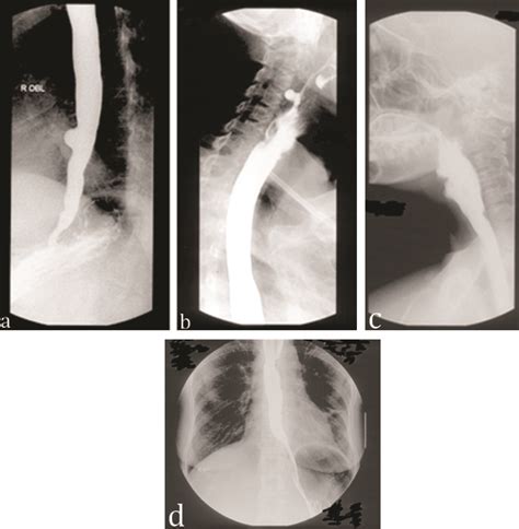 Esophageal Cancer Barium Swallow