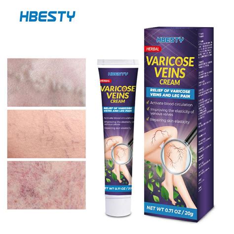 Hbesty Creme Reparador De Varizes Aliviando A Dor Para As Pernas