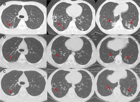 Frontiers Pulmonary Cryptococcosis Diagnosed By Metagenomic Next Generation Sequencing In A