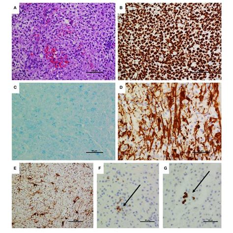 Brain Biopsy Neuropathology A Biopsy Appeared Hypercellular With