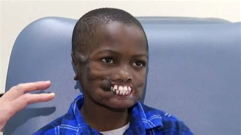 Chimp Attack Survivor To Get Rare Facial Reconstructive Surgery After