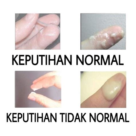 Detail Gambar Keputihan Normal Dan Tdk Normal Koleksi Nomer 12