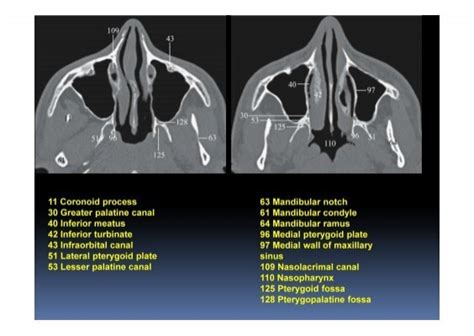 134 Sphenoid Sinus Septum