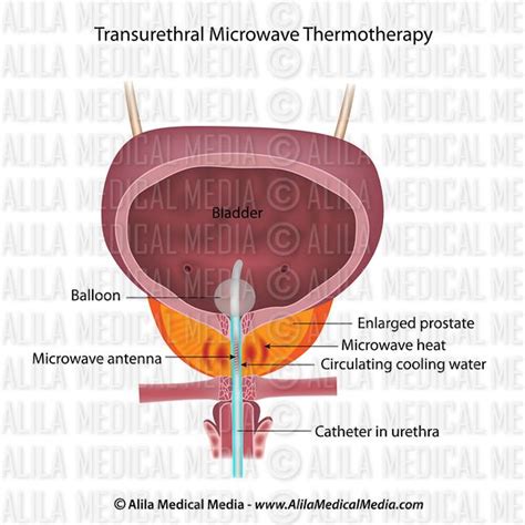 Alila Medical Media Urinary Incontinence Due To Benign Prostatic