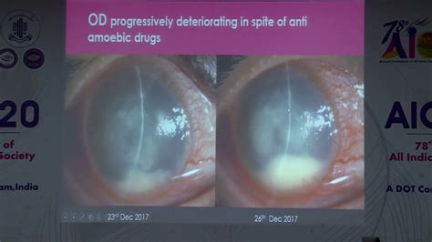 Aioc2020 Fp Cornea Ii Dr Ginni Aggarwal Case Report Of Bilateral Acanthamoeba Keratitis