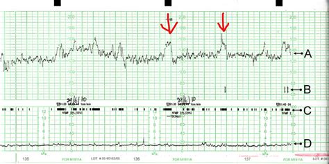 B5 Non Stress Test And Stress Test Ctg Basics Greek Doctor